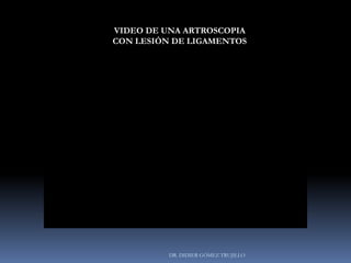 DR. DIDIER GÓMEZ TRUJILLO
VIDEO DE UNA ARTROSCOPIA
CON LESIÓN DE LIGAMENTOS
 