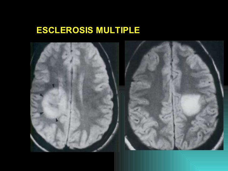 Lesiones metastasicas snc