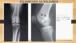 EXAMENES AUXILIARES
Linea de Blumenssat,
cicatriz del cartílago
hialino
 