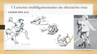 1-Lesiones multiligamentarias sin afectación ósea
• LESION DEL LCA
 