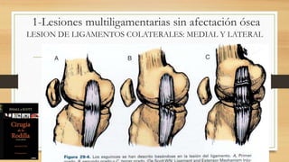 1-Lesiones multiligamentarias sin afectación ósea
LESION DE LIGAMENTOS COLATERALES: MEDIAL Y LATERAL
 