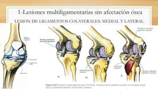 LESION DE LIGAMENTOS COLATERALES: MEDIAL Y LATERAL
1-Lesiones multiligamentarias sin afectación ósea
 