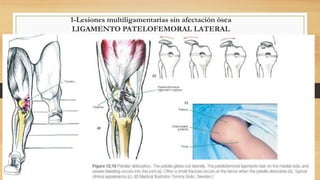 1-Lesiones multiligamentarias sin afectación ósea
LIGAMENTO PATELOFEMORAL LATERAL
 