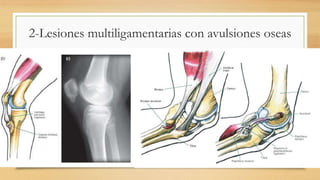 2-Lesiones multiligamentarias con avulsiones oseas
 