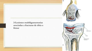 3-Lesiones multiligamentarias
asociadas a fracturas de tibia o
fémur
 