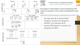 Las fracturas de la meseta tibial
medial se asocian con desgarros
del PLC. Las fracturas de la
meseta tibial lateral se asocian con
desgarros de MCL
 