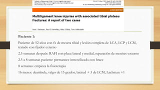 Paciente 1:
Paciente de 52 años con fx de meseta tibial y lesión completa de LCA, LCP y LCM,
tratado con fijador externo
2.5 semanas después: RAFI con placa lateral y medial, reparación de menisco externo
2.5 a 8 semanas paciente permanece inmovilizado con brace
8 semanas: empieza la fisioterapia
16 meses: deambula, valgo de 15 grados, laxitud + 3 de LCM, Lachman +1
 
