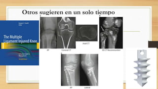 Otros sugieren en un solo tiempo
 