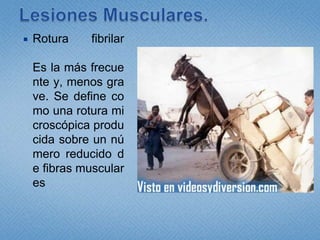 Lesiones Musculares.Rotura fibrilarEs la más frecuente y, menos grave. Se define como una rotura microscópica producida sobre un número reducido de fibras musculares