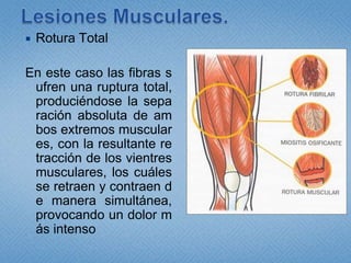 Lesiones Musculares.Rotura TotalEn este caso las fibras sufren una ruptura total, produciéndose la separación absoluta de ambos extremos musculares, con la resultante retracción de los vientres musculares, los cuáles se retraen y contraen de manera simultánea, provocando un dolor más intenso