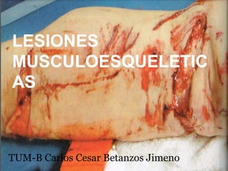 LESIONES
MUSCULOESQUELETIC
AS
TUM-B Carlos Cesar Betanzos Jimeno
 