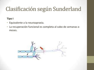 Clasificación según Sunderland
Tipo I
• Equivalente a la neuroapraxia.
• La recuperación funcional es completa al cabo de semanas o
  meses.
 
