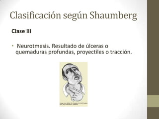 Clasificación según Shaumberg
Clase III

• Neurotmesis. Resultado de úlceras o
  quemaduras profundas, proyectiles o tracción.
 