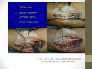 Foto 1: Liberación, epineurotomía longitudinal
      y endoneurolisis del nervio cubital.
 