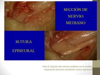 Foto 2: Sección del nervio mediano en la muñeca y
 reparación primaria mediante sutura epineural.
 