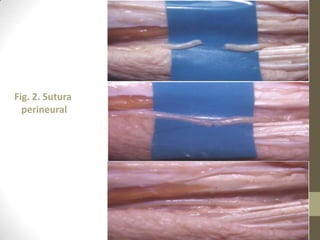 Fig. 2. Sutura
  perineural
 