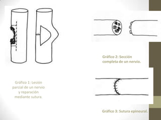 Gráfico 2: Sección
                       completa de un nervio.




 Gráfico 1: Lesión
parcial de un nervio
   y reparación
 mediante sutura.


                       Gráfico 3: Sutura epineural.
 