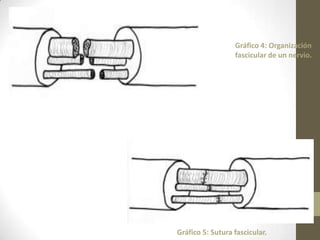 Gráfico 4: Organización
                  fascicular de un nervio.




Gráfico 5: Sutura fascicular.
 