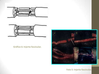 Gráfico 6: Injerto fascicular.




                                 Foto 5: Injerto fascicular.
 