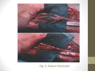 Fig. 3. Sutura fascicular
 