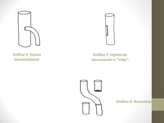 Gráfico 9: Sutura    Gráfico 7: Injerto de
 terminolateral.    incrustación o “inlay”.




                                   Gráfico 8: Neurotización.
 