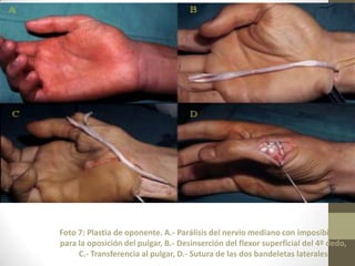 Foto 7: Plastia de oponente. A.- Parálisis del nervio mediano con imposibilidad
para la oposición del pulgar, B.- Desinserción del flexor superficial del 4º dedo,
     C.- Transferencia al pulgar, D.- Sutura de las dos bandeletas laterales
 