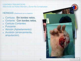 LESIONES TRAUMÁTICAS
Afecciones de Partes Blandas y Duras No Complicadas
HERIDAS (Clasificación por su Aspecto)
Contusa: Sin bordes netos.
Cortante: Con bordes netos.
Contuso Cortantes:
Punzante:
Atrición (Aplastamiento):
Avulsión (arrancamiento,
amputación):
Dr. Vejarano A., Willy
Docente Ortopedia y Traumatología
18
 