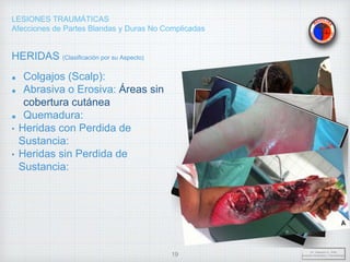 LESIONES TRAUMÁTICAS
Afecciones de Partes Blandas y Duras No Complicadas
HERIDAS (Clasificación por su Aspecto)
Colgajos (Scalp):
Abrasiva o Erosiva: Áreas sin
cobertura cutánea
Quemadura:
• Heridas con Perdida de
Sustancia:
• Heridas sin Perdida de
Sustancia:
Dr. Vejarano A., Willy
Docente Ortopedia y Traumatología
19
 