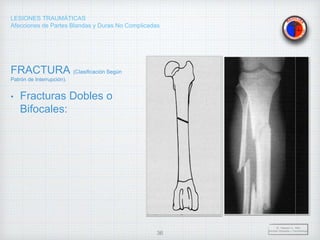 LESIONES TRAUMÁTICAS
Afecciones de Partes Blandas y Duras No Complicadas
FRACTURA (Clasificación Según
Patrón de Interrupción).
• Fracturas Dobles o
Bifocales:
Dr. Vejarano A., Willy
Docente Ortopedia y Traumatología
36
 