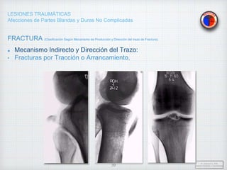 LESIONES TRAUMÁTICAS
Afecciones de Partes Blandas y Duras No Complicadas
FRACTURA (Clasificación Según Mecanismo de Producción y Dirección del trazo de Fractura).
Mecanismo Indirecto y Dirección del Trazo:
• Fracturas por Tracción o Arrancamiento.
Dr. Vejarano A., Willy
Docente Ortopedia y Traumatología
39
 