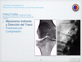 LESIONES TRAUMÁTICAS
Afecciones de Partes Blandas y Duras No Complicadas
FRACTURA (Clasificación Según
Mecanismo de Producción y Dirección del trazo de
Fractura).
Mecanismo Indirecto
y Dirección del Trazo:
• Fracturas por
Compresión:
Dr. Vejarano A., Willy
Docente Ortopedia y Traumatología
40
 