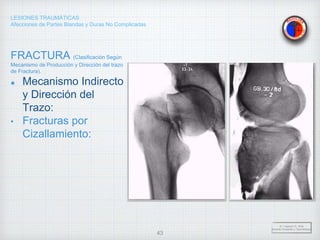 LESIONES TRAUMÁTICAS
Afecciones de Partes Blandas y Duras No Complicadas
FRACTURA (Clasificación Según
Mecanismo de Producción y Dirección del trazo
de Fractura).
Mecanismo Indirecto
y Dirección del
Trazo:
• Fracturas por
Cizallamiento:
Dr. Vejarano A., Willy
Docente Ortopedia y Traumatología
43
 