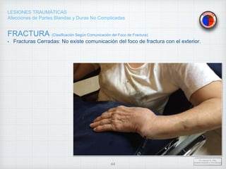 LESIONES TRAUMÁTICAS
Afecciones de Partes Blandas y Duras No Complicadas
FRACTURA (Clasificación Según Comunicación del Foco de Fractura).
• Fracturas Cerradas: No existe comunicación del foco de fractura con el exterior.
Dr. Vejarano A., Willy
Docente Ortopedia y Traumatología
44
 