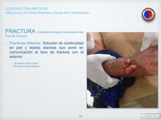 LESIONES TRAUMÁTICAS
Afecciones de Partes Blandas y Duras No Complicadas
FRACTURA (Clasificación Según Comunicación del
Foco de Fractura).
• Fracturas Abiertas: Solución de continuidad
en piel y tejidos blandos que pone en
comunicación el foco de fractura con el
exterior.
- De dentro hacia fuera.
- De fuera hacia adentro.
Dr. Vejarano A., Willy
Docente Ortopedia y Traumatología
45
 