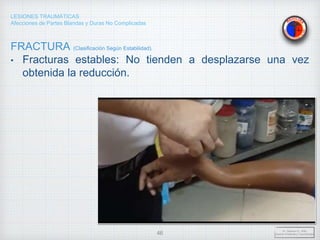 LESIONES TRAUMÁTICAS
Afecciones de Partes Blandas y Duras No Complicadas
FRACTURA (Clasificación Según Estabilidad).
• Fracturas estables: No tienden a desplazarse una vez
obtenida la reducción.
Dr. Vejarano A., Willy
Docente Ortopedia y Traumatología
46
 