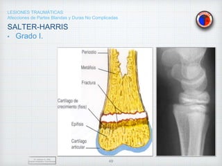 LESIONES TRAUMÁTICAS
Afecciones de Partes Blandas y Duras No Complicadas
SALTER-HARRIS
• Grado I.
Dr. Vejarano A., Willy
Docente Ortopedia y Traumatología 49
 