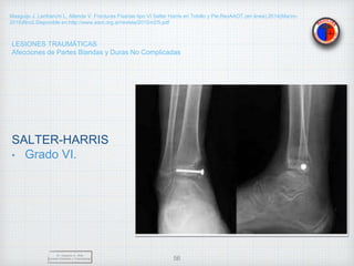 LESIONES TRAUMÁTICAS
Afecciones de Partes Blandas y Duras No Complicadas
SALTER-HARRIS
• Grado VI.
Dr. Vejarano A., Willy
Docente Ortopedia y Traumatología 56
Masguijo J, Lanfranchi L, Allende V. Fracturas Fisarias tipo VI Salter Harris en Tobillo y Pie.RevAAOT.(en linea).2014(Marzo-
2019)Nro2.Disponible en:http://www.aaot.org.ar/revista/2015/n2/5.pdf
 