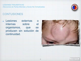 LESIONES TRAUMÁTICAS
Afecciones de Partes Blandas y Duras No Complicadas
CONTUSIONES
Lesiones externas o
internas sobre el
organismos, que se
producen sin solución de
continuidad.
Dr. Vejarano A., Willy
Docente Ortopedia y Traumatología
6
 