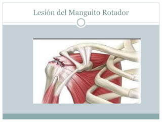 Lesión del Manguito Rotador
 