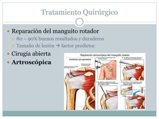 Tratamiento Quirúrgico
 Reparación del manguito rotador
 80 – 90% buenos resultados y duraderos
 Tamaño de lesión  factor predictor
 Cirugía abierta
 Artroscópica
 