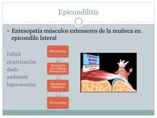 Epicondilitis
 Entesopatía músculos extensores de la muñeca en
epicondilo lateral
Difícil
cicatrización
dado
ambiente
hipovascular
Microtrauma
Reparación
con colágeno
desorganizado
Fibroblastos
inmaduros
Entoesopatia
 