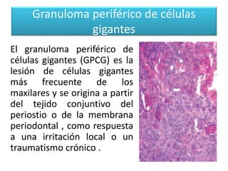 Granuloma periférico de células
gigantes
El granuloma periférico de
células gigantes (GPCG) es la
lesión de células gigantes
más frecuente de los
maxilares y se origina a partir
del tejido conjuntivo del
periostio o de la membrana
periodontal , como respuesta
a una irritación local o un
traumatismo crónico .

 