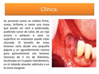 Clínica.
Se presenta como un nódulo firme,
suave, brillante o como una masa
que puede ser sésil o pediculada,
pudiendo variar de color, de un rojo
oscuro a púrpura o azul; su
superficie en ocasiones puede estar
ulcerada. El tamaño de estas
lesiones varía desde una pequeña
pápula a un agrandamiento masivo
pero generalmente son lesiones
menores de 2 cm de diámetro,
localizadas en la papila interdentaria,
en el reborde alveolar edéntulo o en
la encía marginal.

 