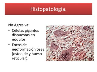 Histopatología.
No Agresiva:
• Células gigantes
dispuestas en
nódulos.
• Focos de
neoformación ósea
(osteoide y hueso
reticular).

 