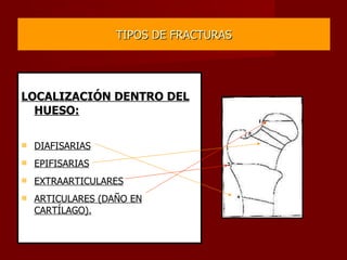TIPOS DE FRACTURAS LOCALIZACIÓN DENTRO DEL HUESO: DIAFISARIAS EPIFISARIAS EXTRAARTICULARES ARTICULARES (DAÑO EN CARTÍLAGO). 
