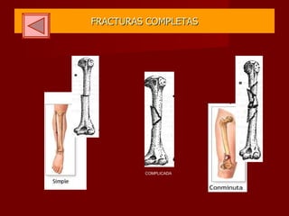 FRACTURAS COMPLETAS COMPLICADA 
