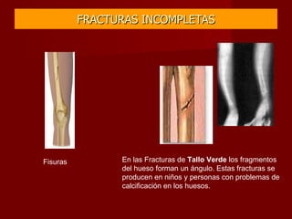 FRACTURAS INCOMPLETAS Fisuras En las Fracturas de  Tallo Verde  los fragmentos del hueso forman un ángulo. Estas fracturas se producen en niños y personas con problemas de calcificación en los huesos. 