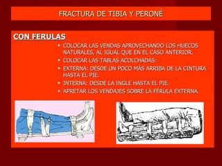 FRACTURA DE TIBIA Y PERONÉ CON FERULAS COLOCAR LAS VENDAS APROVECHANDO LOS HUECOS NATURALES, AL IGUAL QUE EN EL CASO ANTERIOR. COLOCAR LAS TABLAS ACOLCHADAS: EXTERNA: DESDE UN POCO MÁS ARRIBA DE LA CINTURA HASTA EL PIE. INTERNA: DESDE LA INGLE HASTA EL PIE. APRETAR LOS VENDAJES SOBRE LA FÉRULA EXTERNA. 