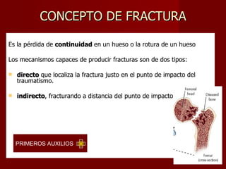 CONCEPTO DE FRACTURA Es la pérdida de  continuidad  en un hueso o la rotura de un hueso   Los mecanismos capaces de producir fracturas son de dos tipos: directo  que localiza la fractura justo en el punto de impacto del traumatismo. indirecto , fracturando a distancia del punto de impacto. PRIMEROS AUXILIOS  
