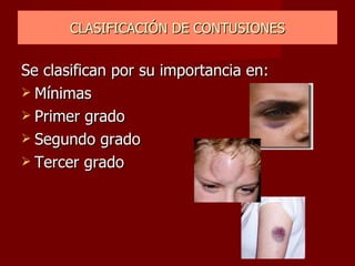 CLASIFICACIÓN DE CONTUSIONES Se clasifican por su importancia en: Mínimas Primer grado Segundo grado Tercer grado 